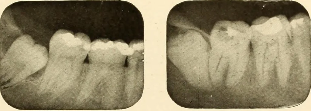 An illustration from Oral Roentgenology : a Roentgen study of the anatomy and pathology of the oral cavity, 1917, leaf 66
