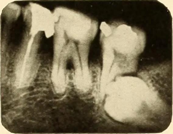 An illustration from Oral Roentgenology : a Roentgen study of the anatomy and pathology of the oral cavity, 1917, leaf 68
