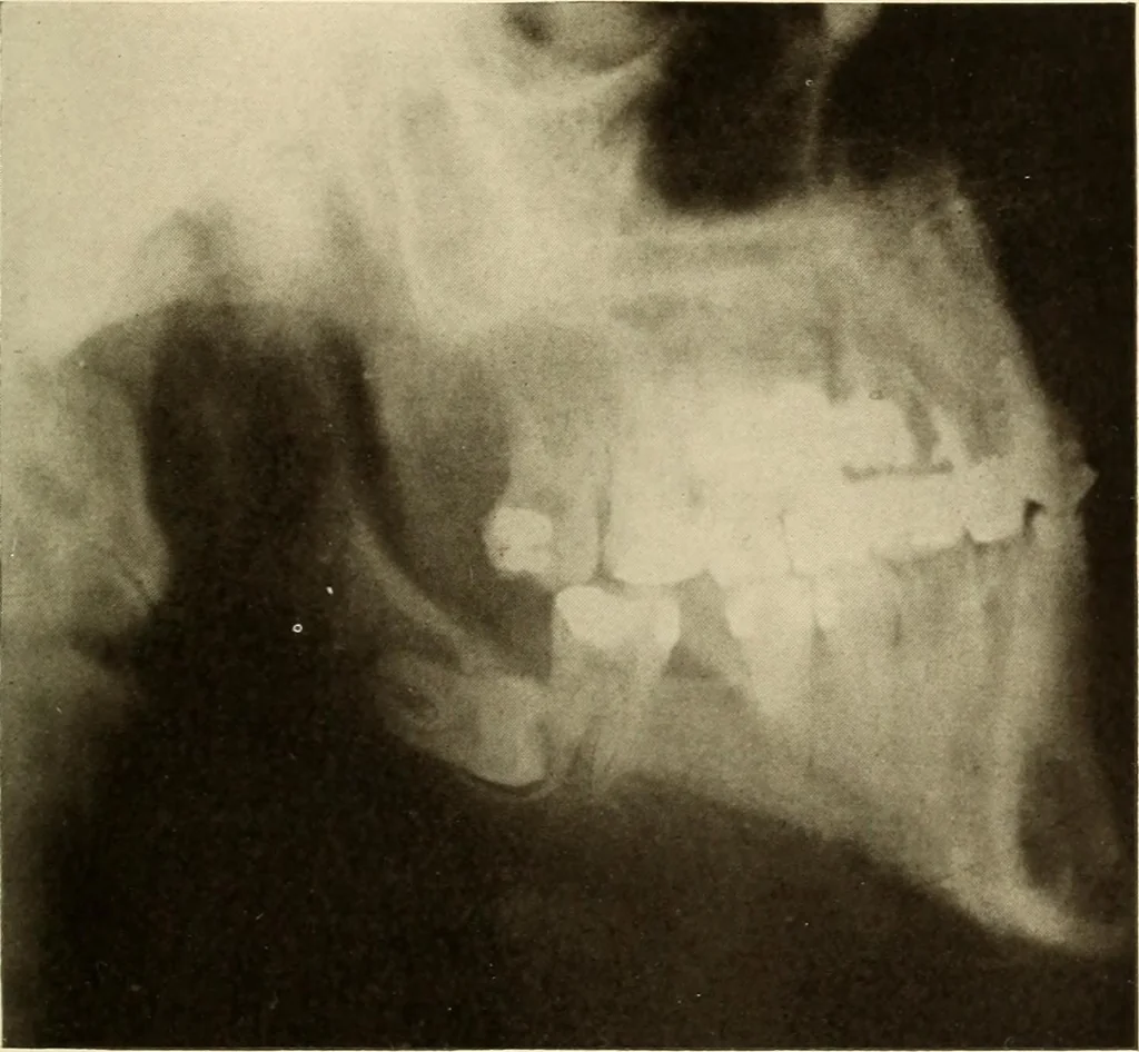 An illustration from Oral Roentgenology : a Roentgen study of the anatomy and pathology of the oral cavity, 1917, leaf 68