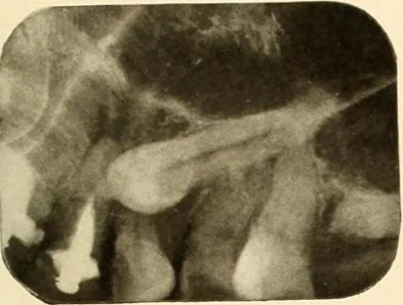An illustration from Oral Roentgenology : a Roentgen study of the anatomy and pathology of the oral cavity, 1917, leaf 72