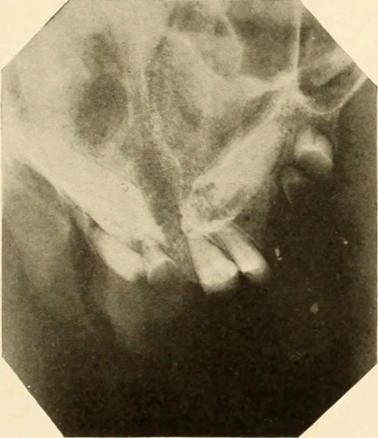An illustration from Oral Roentgenology : a Roentgen study of the anatomy and pathology of the oral cavity, 1917, leaf 72