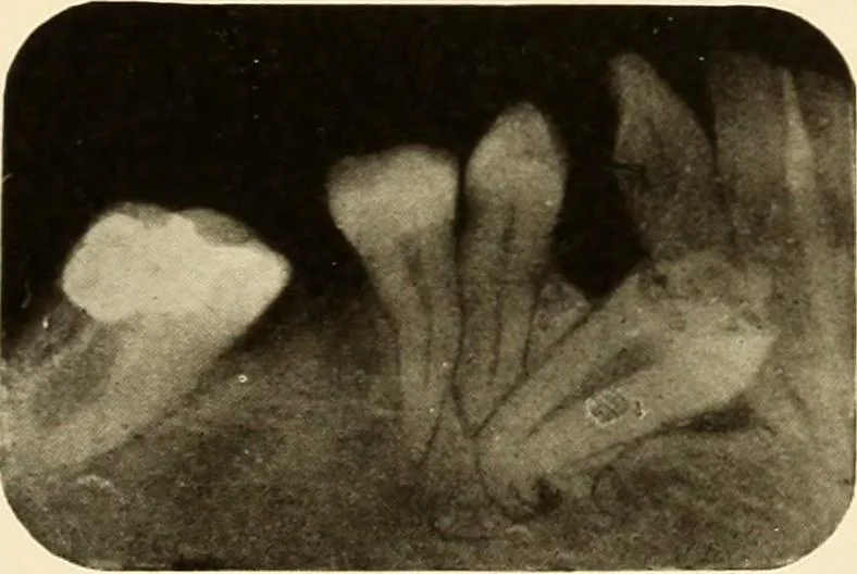 An illustration from Oral Roentgenology : a Roentgen study of the anatomy and pathology of the oral cavity, 1917, leaf 72