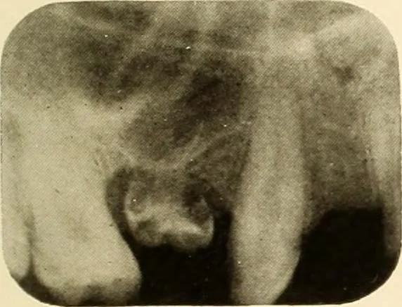 An illustration from Oral Roentgenology : a Roentgen study of the anatomy and pathology of the oral cavity, 1917, leaf 74