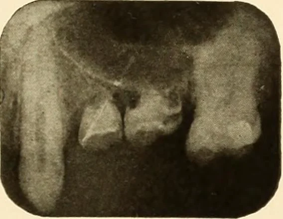 An illustration from Oral Roentgenology : a Roentgen study of the anatomy and pathology of the oral cavity, 1917, leaf 74