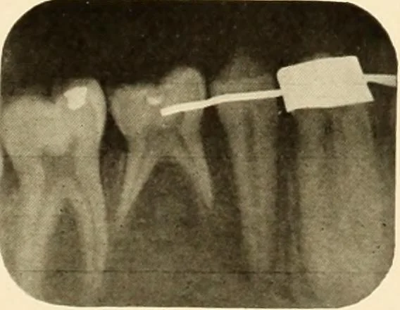An illustration from Oral Roentgenology : a Roentgen study of the anatomy and pathology of the oral cavity, 1917, leaf 74