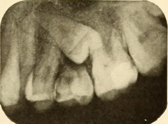 An illustration from Oral Roentgenology : a Roentgen study of the anatomy and pathology of the oral cavity, 1917, leaf 76