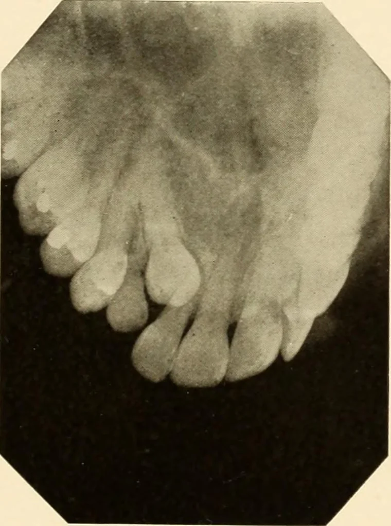 An illustration from Oral Roentgenology : a Roentgen study of the anatomy and pathology of the oral cavity, 1917, leaf 76