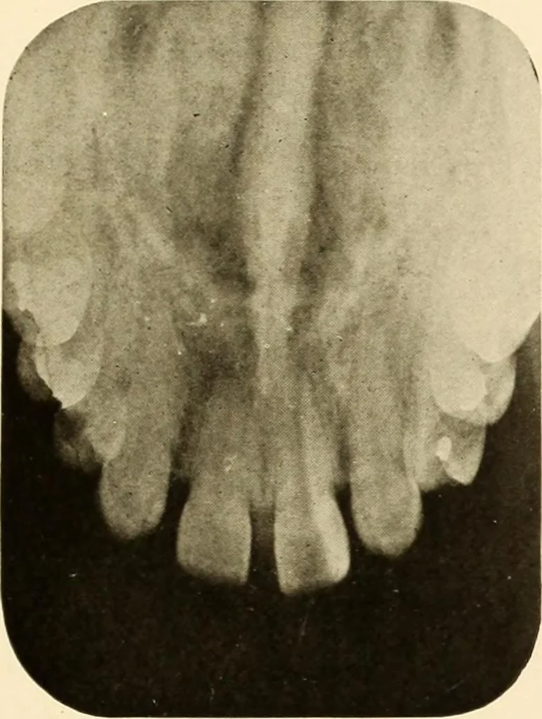 An illustration from Oral Roentgenology : a Roentgen study of the anatomy and pathology of the oral cavity, 1917, leaf 78