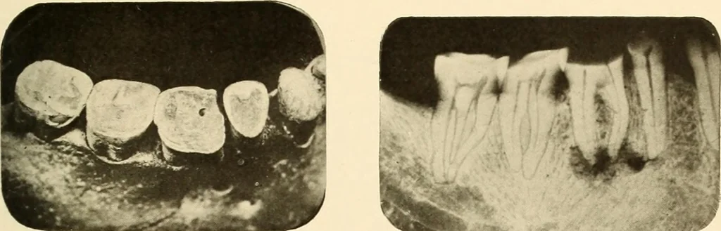 An illustration from Oral Roentgenology : a Roentgen study of the anatomy and pathology of the oral cavity, 1917, leaf 82