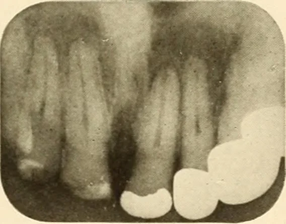 An illustration from Oral Roentgenology : a Roentgen study of the anatomy and pathology of the oral cavity, 1917, leaf 82