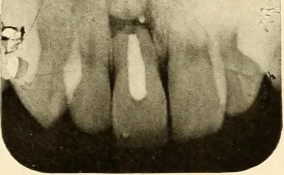 An illustration from Oral Roentgenology : a Roentgen study of the anatomy and pathology of the oral cavity, 1917, leaf 84