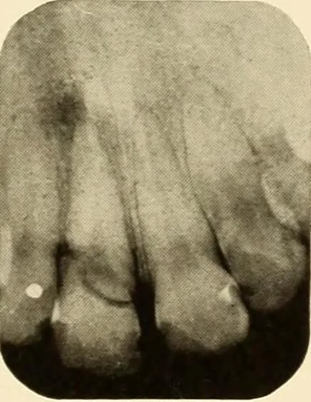 An illustration from Oral Roentgenology : a Roentgen study of the anatomy and pathology of the oral cavity, 1917, leaf 84