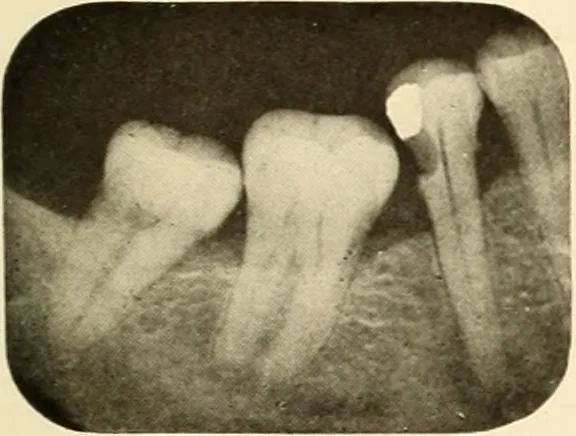 An illustration from Oral Roentgenology : a Roentgen study of the anatomy and pathology of the oral cavity, 1917, leaf 86