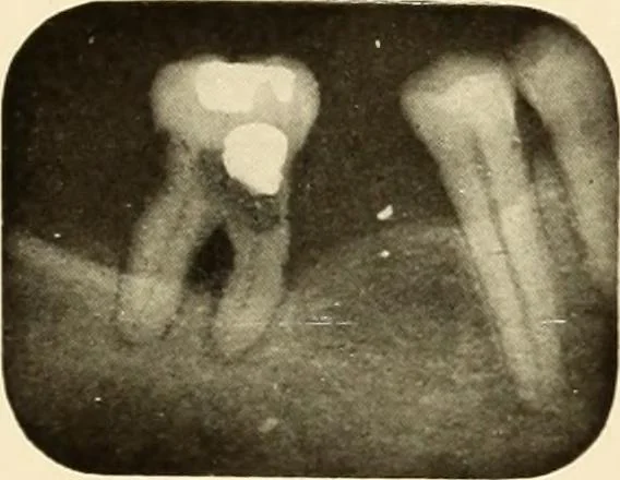 An illustration from Oral Roentgenology : a Roentgen study of the anatomy and pathology of the oral cavity, 1917, leaf 86