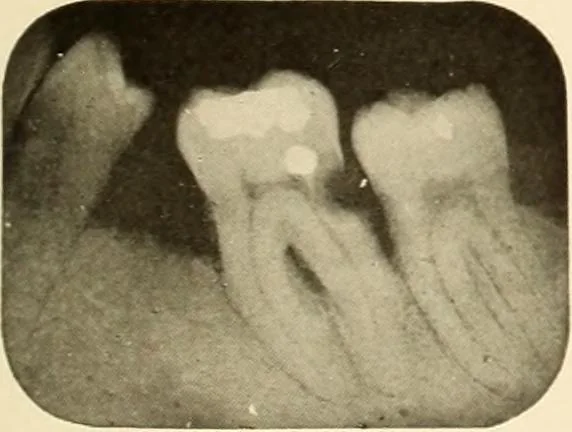 An illustration from Oral Roentgenology : a Roentgen study of the anatomy and pathology of the oral cavity, 1917, leaf 86