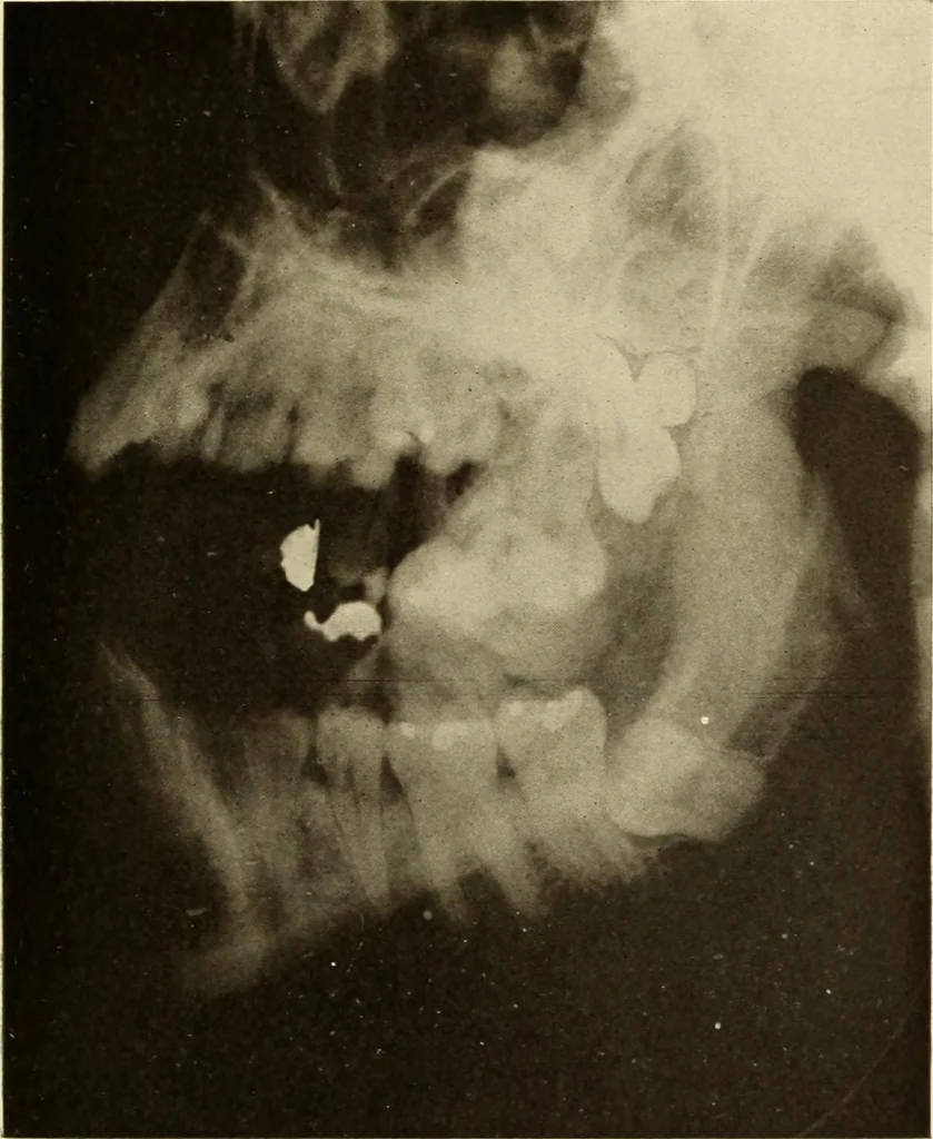 An illustration from Oral Roentgenology : a Roentgen study of the anatomy and pathology of the oral cavity, 1917, leaf 90