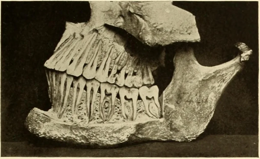 An illustration from Oral Roentgenology : a Roentgen study of the anatomy and pathology of the oral cavity, 1917, leaf 96