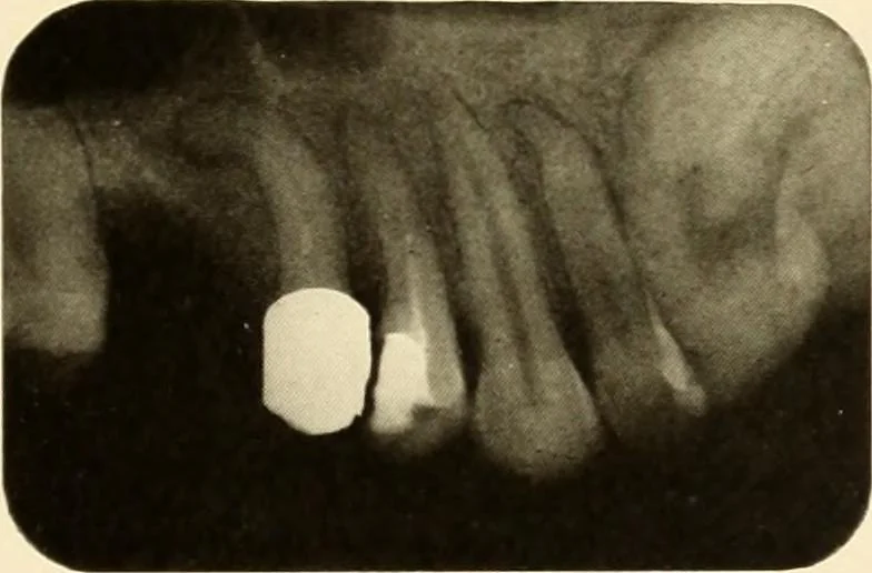 An illustration from Oral Roentgenology : a Roentgen study of the anatomy and pathology of the oral cavity, 1917, leaf 96