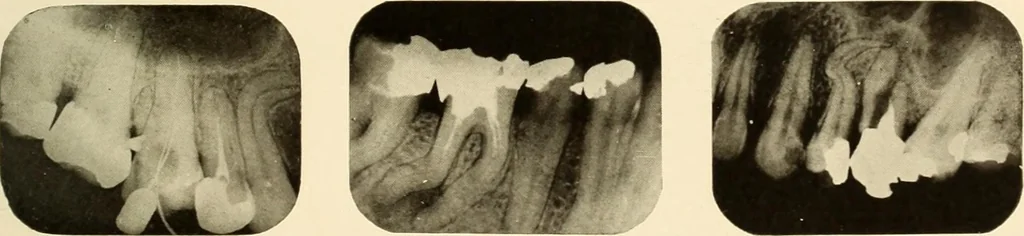 An illustration from Oral Roentgenology : a Roentgen study of the anatomy and pathology of the oral cavity, 1917, leaf 96