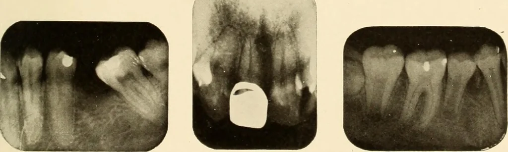 An illustration from Oral Roentgenology : a Roentgen study of the anatomy and pathology of the oral cavity, 1917, leaf 96