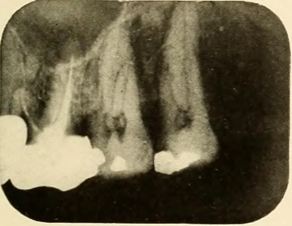 An illustration from Oral Roentgenology : a Roentgen study of the anatomy and pathology of the oral cavity, 1917, leaf 98
