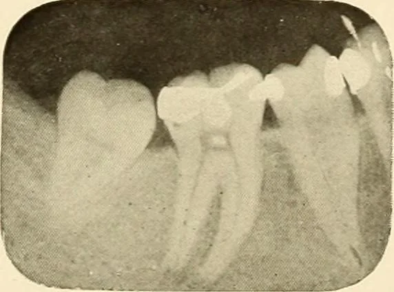 An illustration from Oral Roentgenology : a Roentgen study of the anatomy and pathology of the oral cavity, 1917, leaf 98