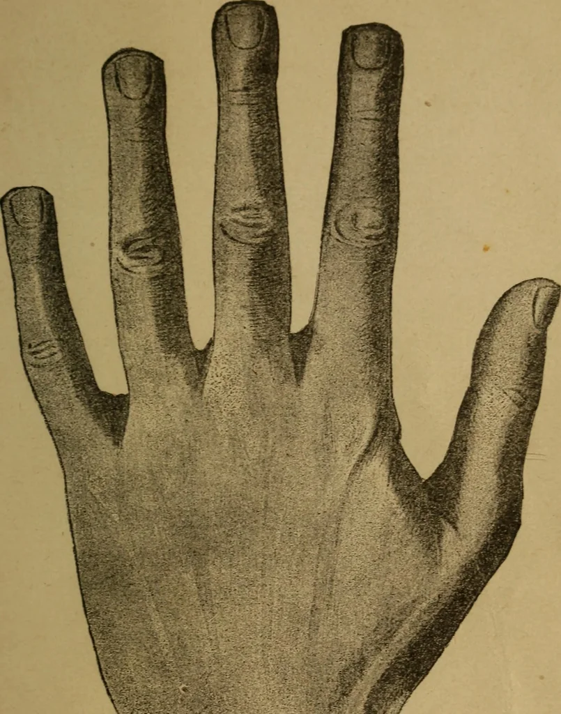 An illustration from Practical cheirosophy, a synoptical study of the science of the hand, 1887, leaf 72