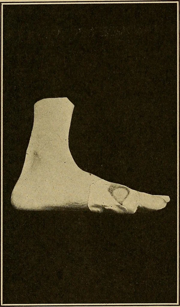 An illustration from Practical podiatry :, 1918, leaf 123