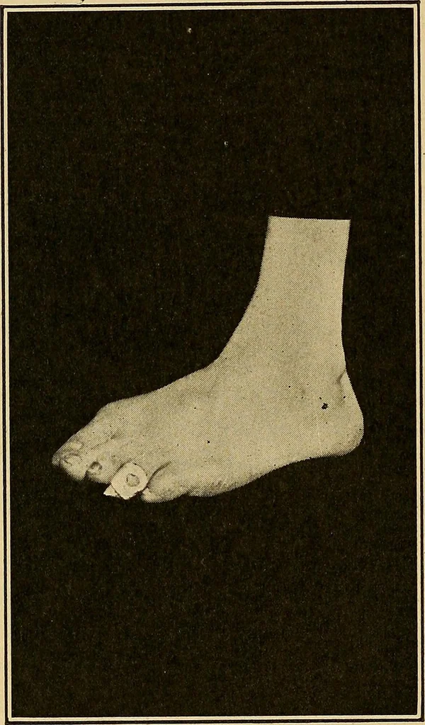 An illustration from Practical podiatry :, 1918, leaf 127