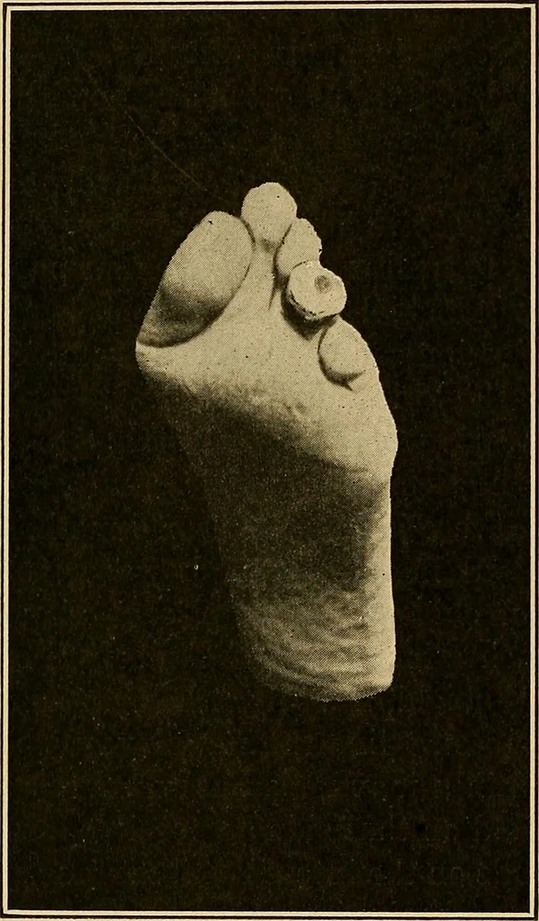 An illustration from Practical podiatry :, 1918, leaf 131