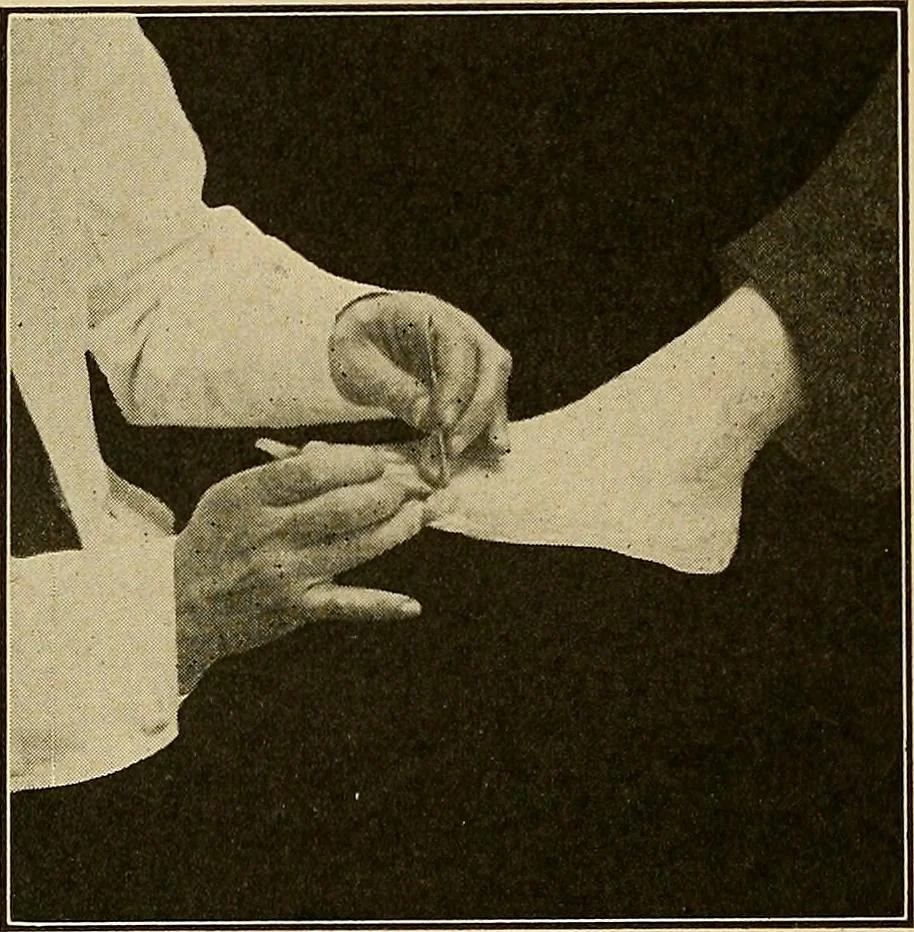 An illustration from Practical podiatry :, 1918, leaf 177