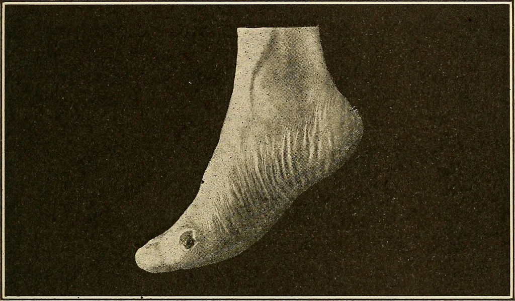 An illustration from Practical podiatry :, 1918, leaf 284