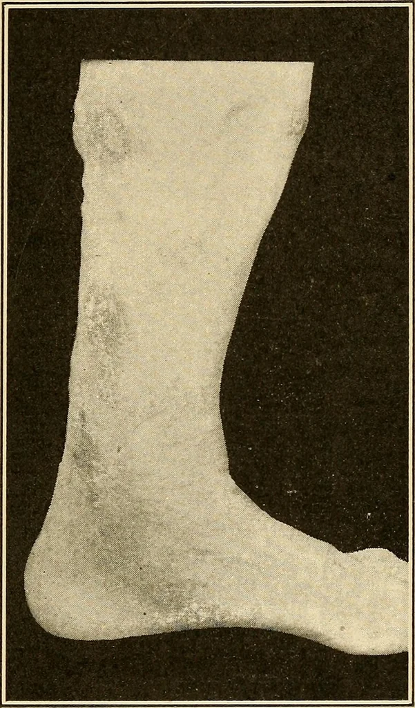 An illustration from Practical podiatry :, 1918, leaf 336