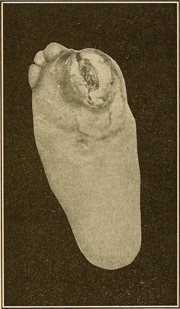 An illustration from Practical podiatry :, 1918, leaf 338