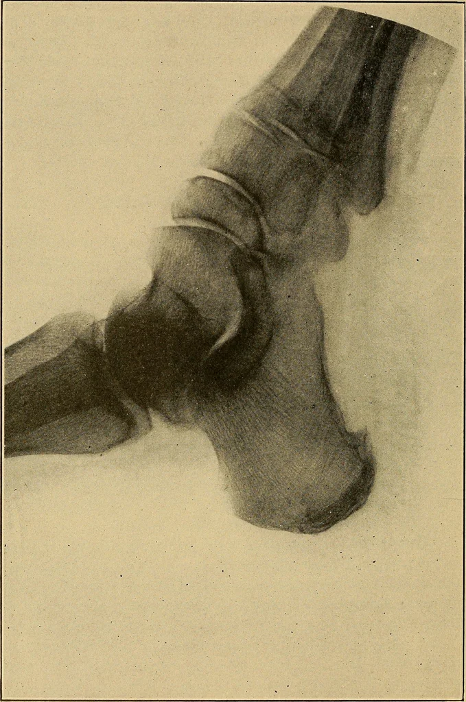 An illustration from Practical podiatry :, 1918, leaf 411