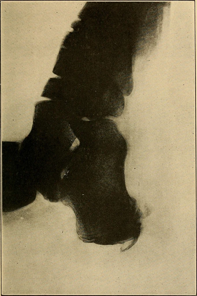 An illustration from Practical podiatry :, 1918, leaf 414