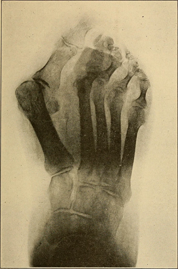 An illustration from Practical podiatry :, 1918, leaf 416