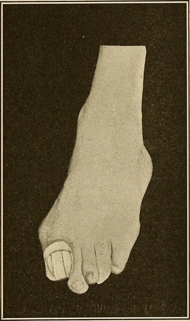 An illustration from Practical podiatry :, 1918, leaf 76