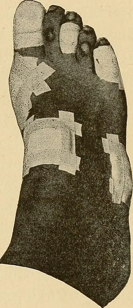 An illustration from Practical podiatry :, 1918, leaf 80