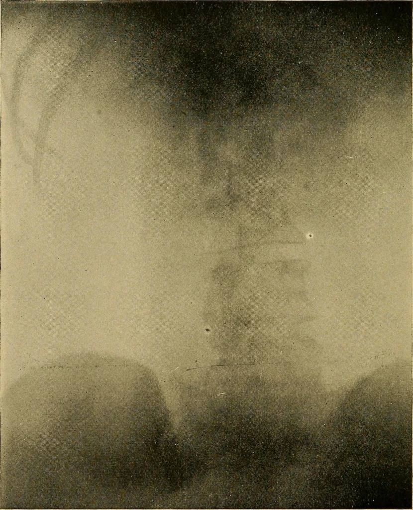 An illustration from Practical radiography : a handbook for physicians, surgeons, and other users of X-rays, 1901, leaf 115