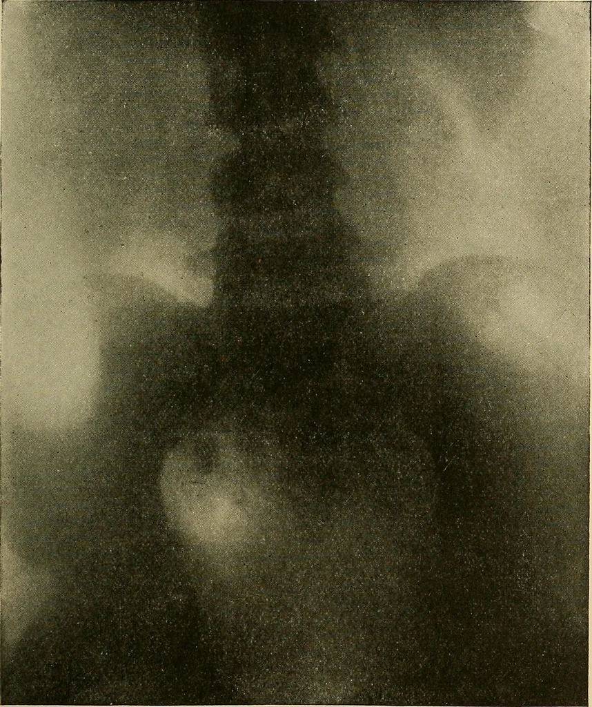 An illustration from Practical radiography : a handbook for physicians, surgeons, and other users of X-rays, 1901, leaf 132
