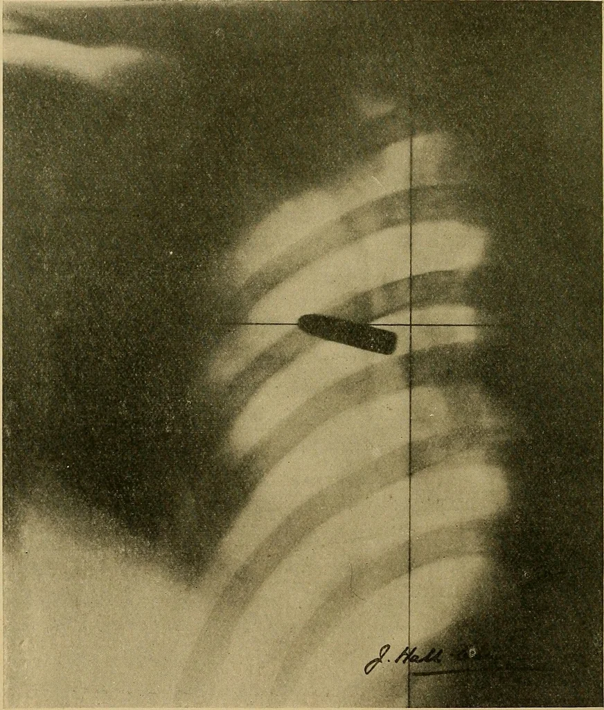 An illustration from Practical radiography : a handbook for physicians, surgeons, and other users of X-rays, 1901, leaf 151