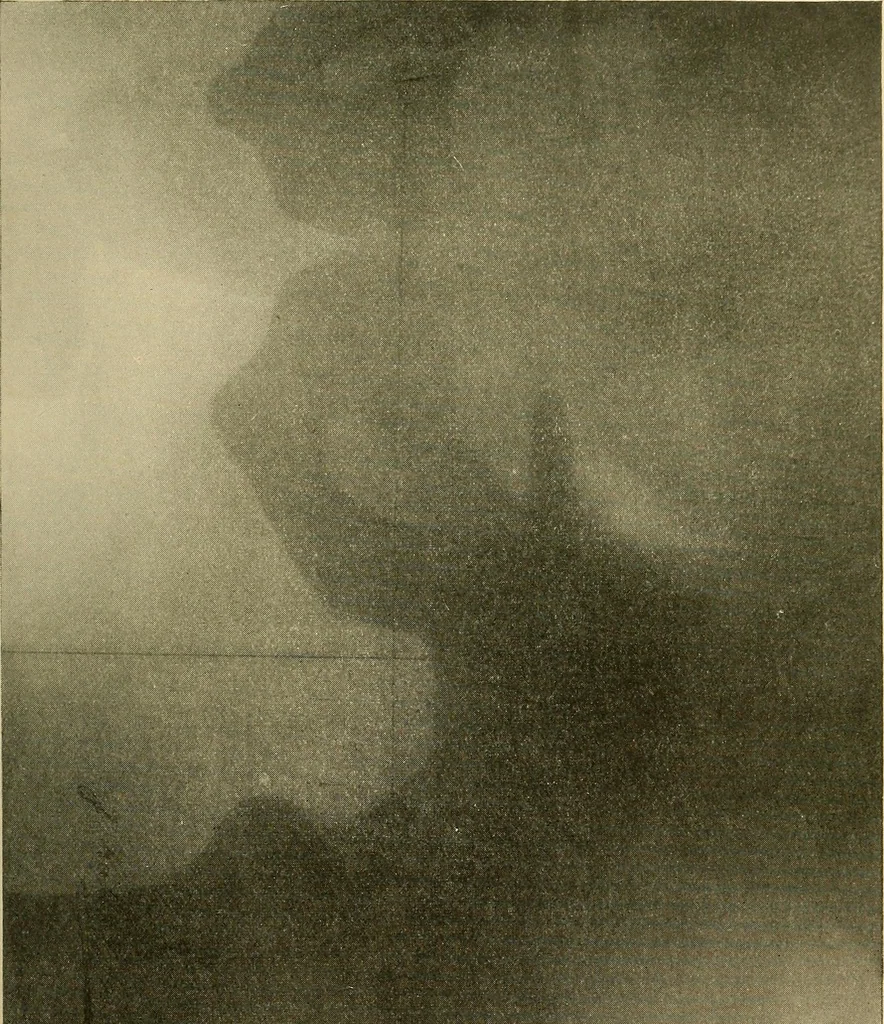 An illustration from Practical radiography : a handbook for physicians, surgeons, and other users of X-rays, 1901, leaf 168