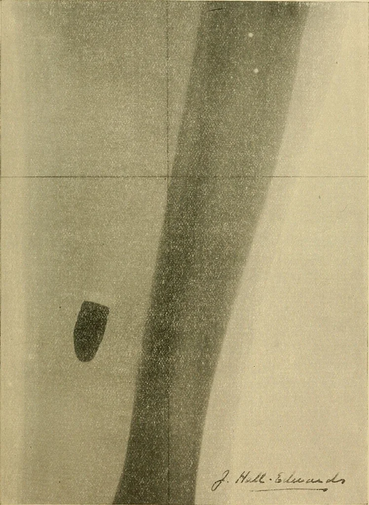 An illustration from Practical radiography : a handbook for physicians, surgeons, and other users of X-rays, 1901, leaf 224