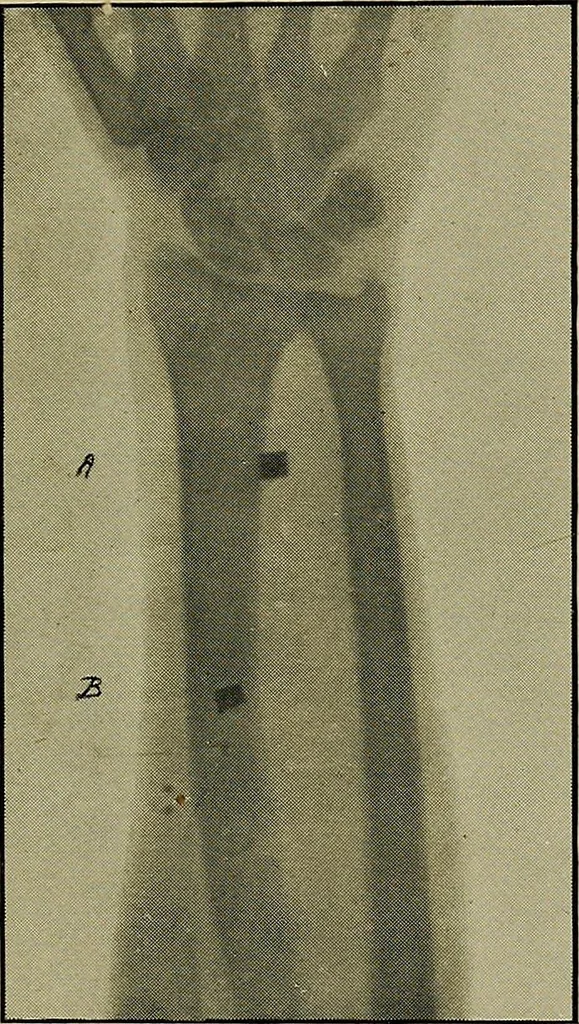 An illustration from Practical X ray work, 1901, leaf 174