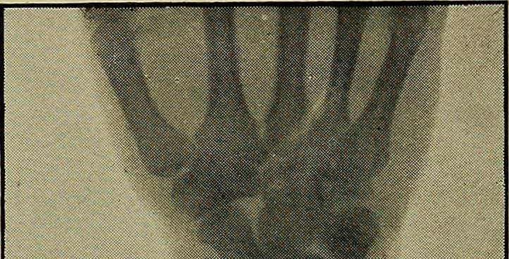 An illustration from Practical X ray work, 1901, leaf 174
