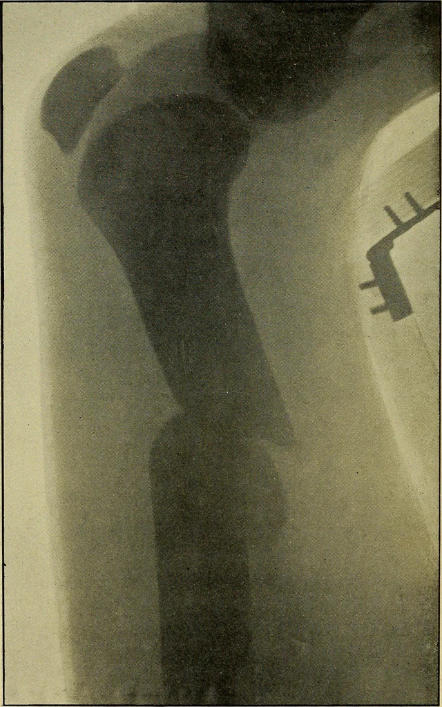 An illustration from Practical X ray work, 1901, leaf 221