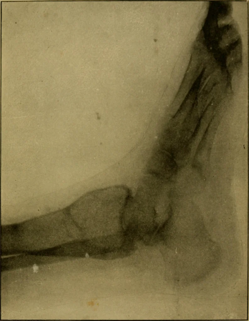 An illustration from Radiography and the 'X' rays in practice and theory : with constructional manipulatory details, 1898, leaf 196