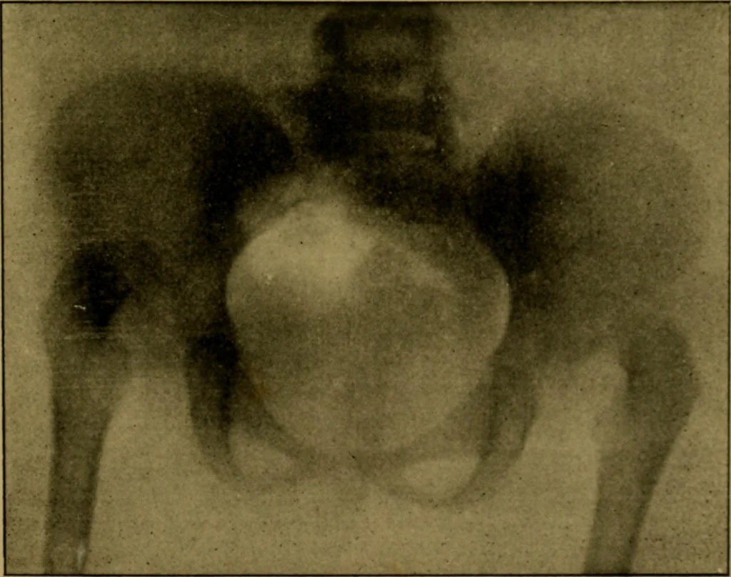 An illustration from Radiography and the 'X' rays in practice and theory : with constructional manipulatory details, 1898, leaf 198