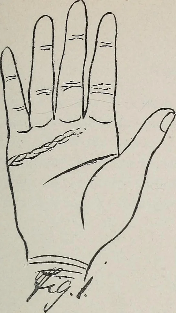 An illustration from Revelations of the hand. A scientific study of the shape and markings of the hand, as an index to character, disease, and tendencies, with explanatory illustrations, 1900, leaf 102